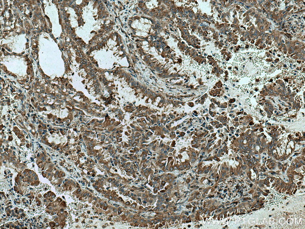 IHC staining of human lung cancer using 66628-1-Ig