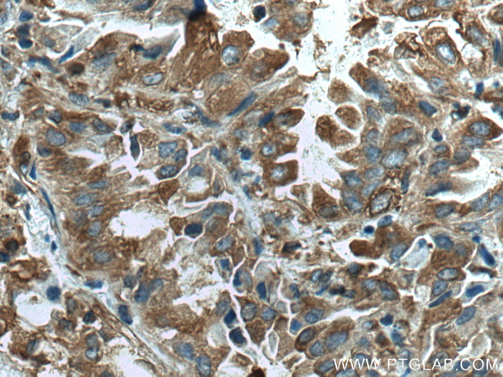 IHC staining of human lung cancer using 66628-1-Ig
