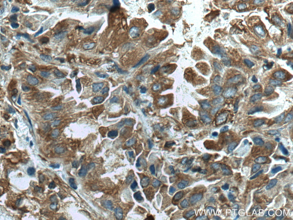 Immunohistochemistry (IHC) staining of human lung cancer tissue using ACTN4 Monoclonal antibody (66628-1-Ig)