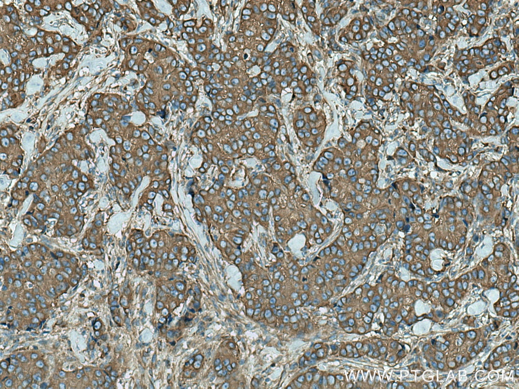 IHC staining of human breast cancer using 66628-1-Ig