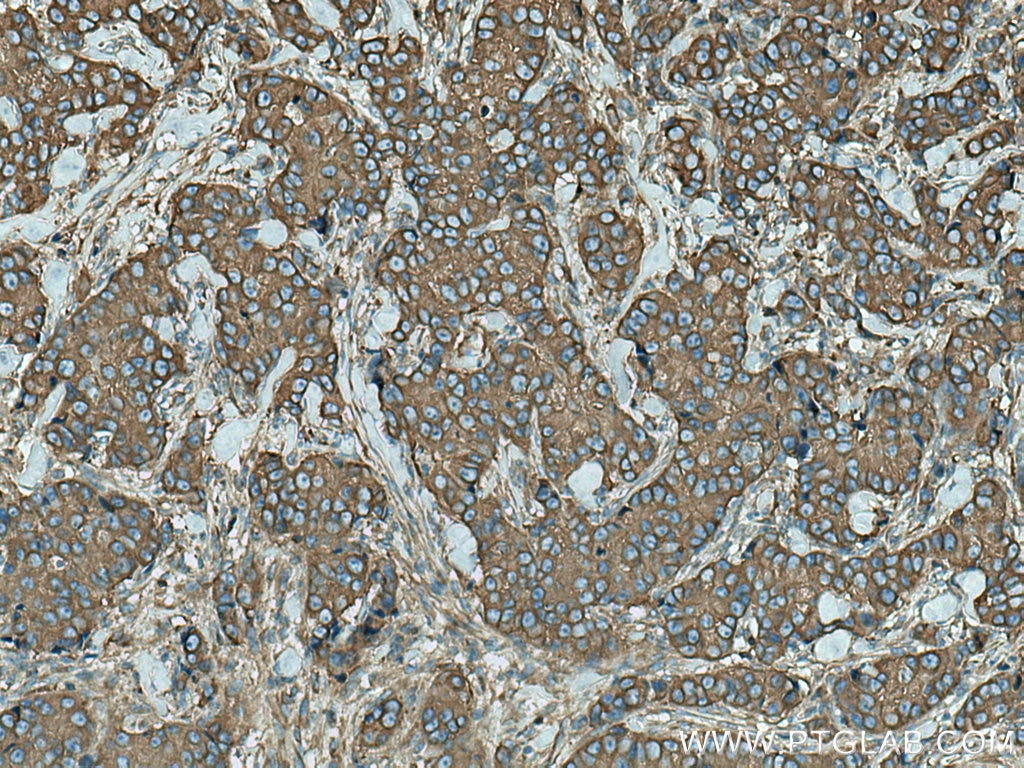 Immunohistochemistry (IHC) staining of human breast cancer tissue using ACTN4 Monoclonal antibody (66628-1-Ig)