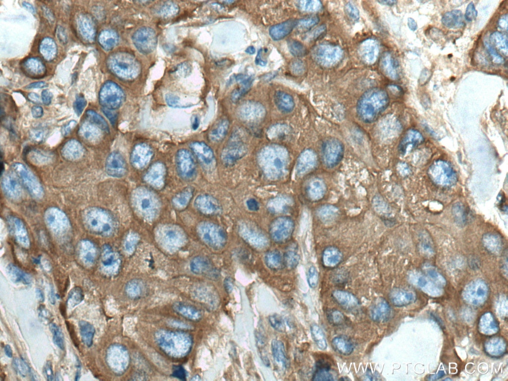 IHC staining of human breast cancer using 66628-1-Ig