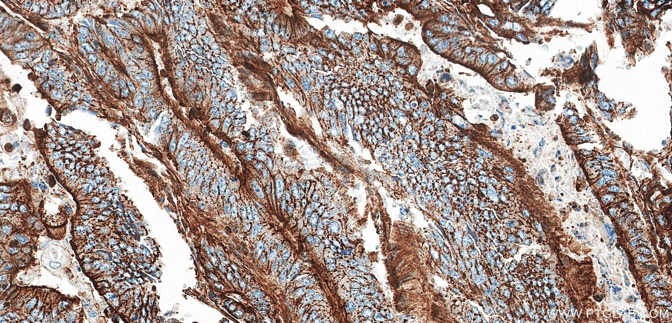 Immunohistochemistry (IHC) staining of human colon cancer tissue using ACTN4 Recombinant monoclonal antibody (87922-1-RR)