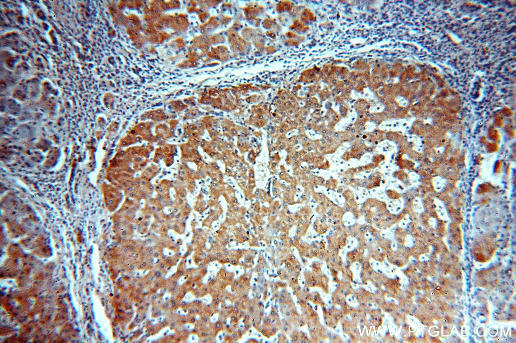 Immunohistochemistry (IHC) staining of human hepatocirrhosis tissue using ACTR10 Polyclonal antibody (20101-1-AP)