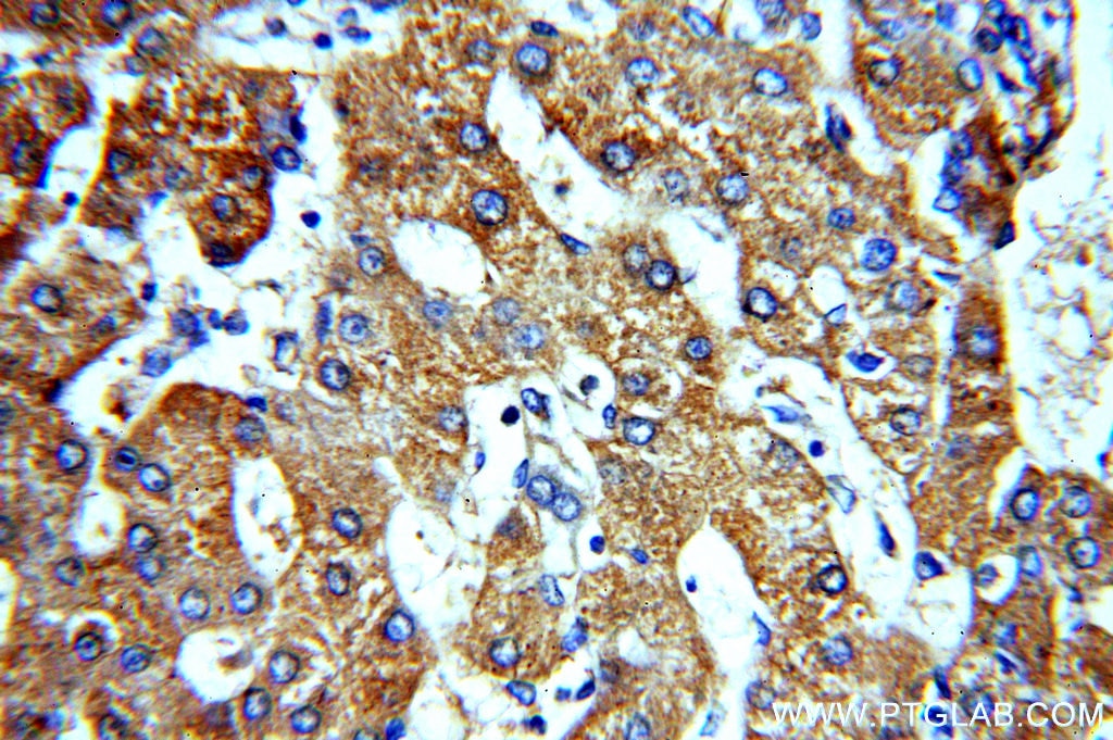 Immunohistochemistry (IHC) staining of human hepatocirrhosis tissue using ACTR10 Polyclonal antibody (20101-1-AP)