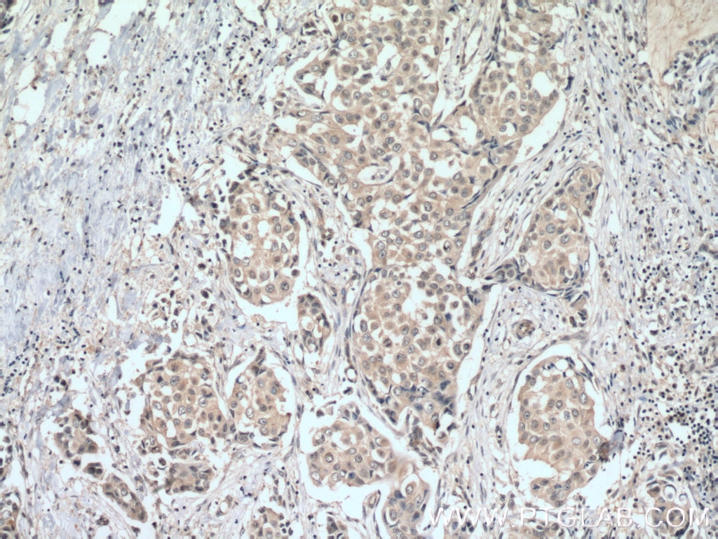 Immunohistochemistry (IHC) staining of human breast cancer tissue using ACTR1B Polyclonal antibody (11023-1-AP)