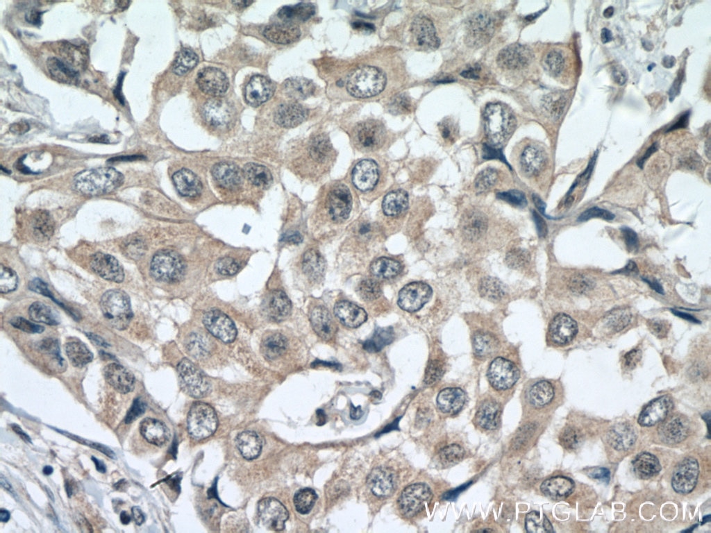 Immunohistochemistry (IHC) staining of human breast cancer tissue using ACTR1B Polyclonal antibody (11023-1-AP)