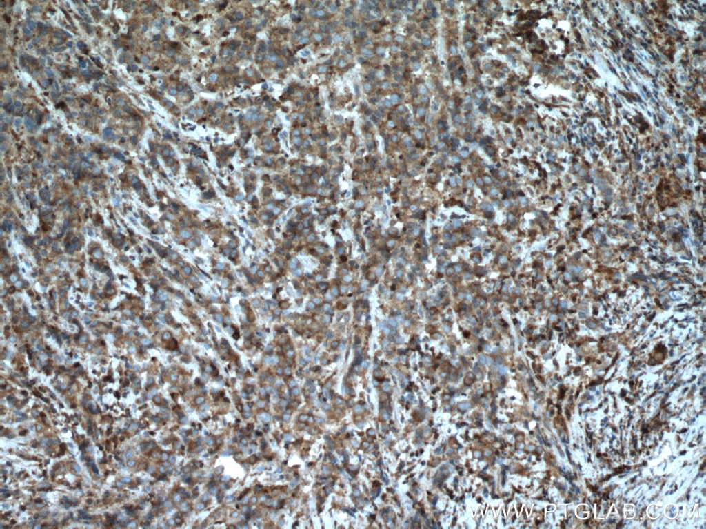 Immunohistochemistry (IHC) staining of human prostate cancer tissue using ARP2 Polyclonal antibody (10922-1-AP)