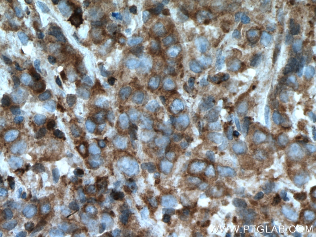 Immunohistochemistry (IHC) staining of human prostate cancer tissue using ARP2 Polyclonal antibody (10922-1-AP)