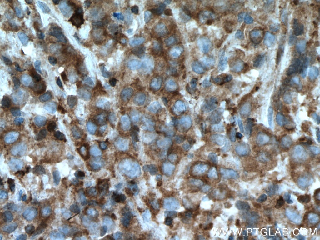 IHC staining of human prostate cancer using 10922-1-AP