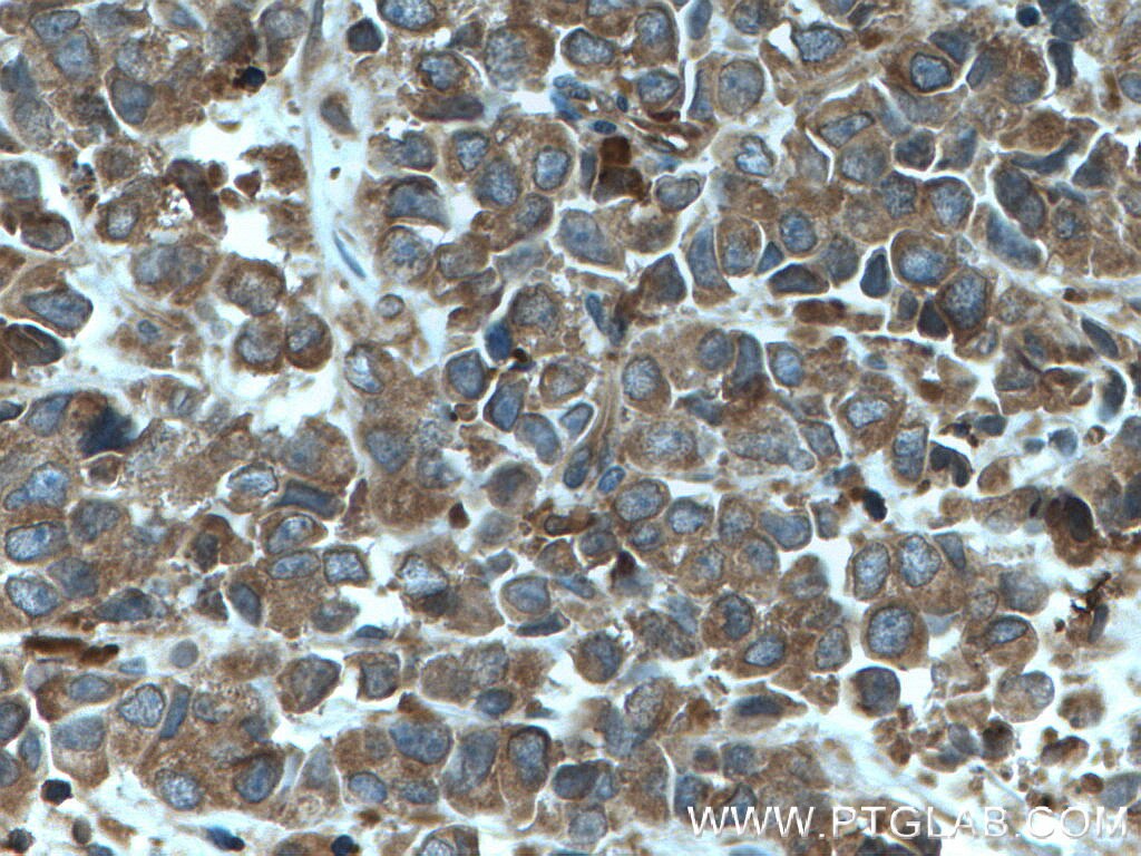 Immunohistochemistry (IHC) staining of human prostate cancer tissue using ARP2 Polyclonal antibody (10922-1-AP)