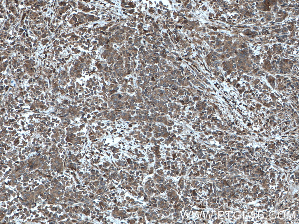 Immunohistochemistry (IHC) staining of human prostate cancer tissue using ARP2 Polyclonal antibody (10922-1-AP)