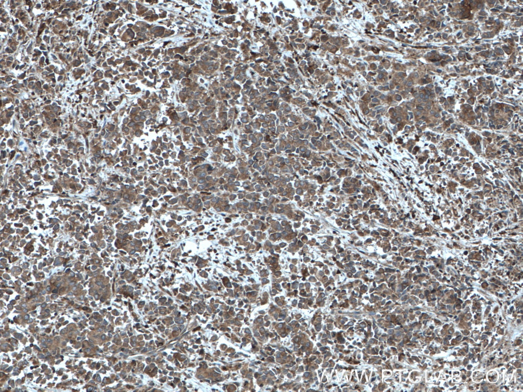 IHC staining of human prostate cancer using 10922-1-AP