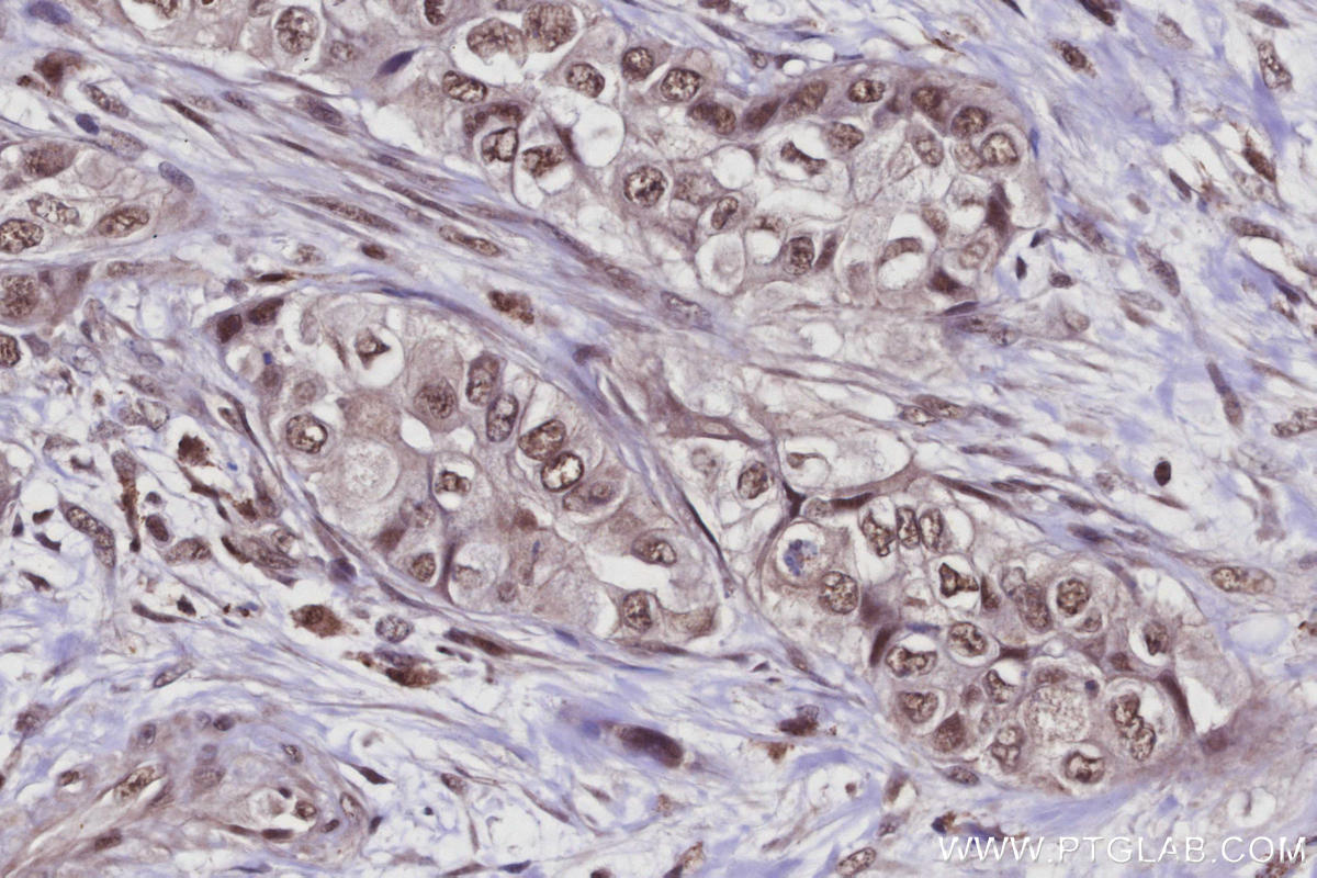 IHC staining of human pancreas cancer using 21505-1-AP Immunohistochemistry (IHC) staining of human pancreas cancer tissue using Arp5/ACTR5 Polyclonal antibody (21505-1-AP)