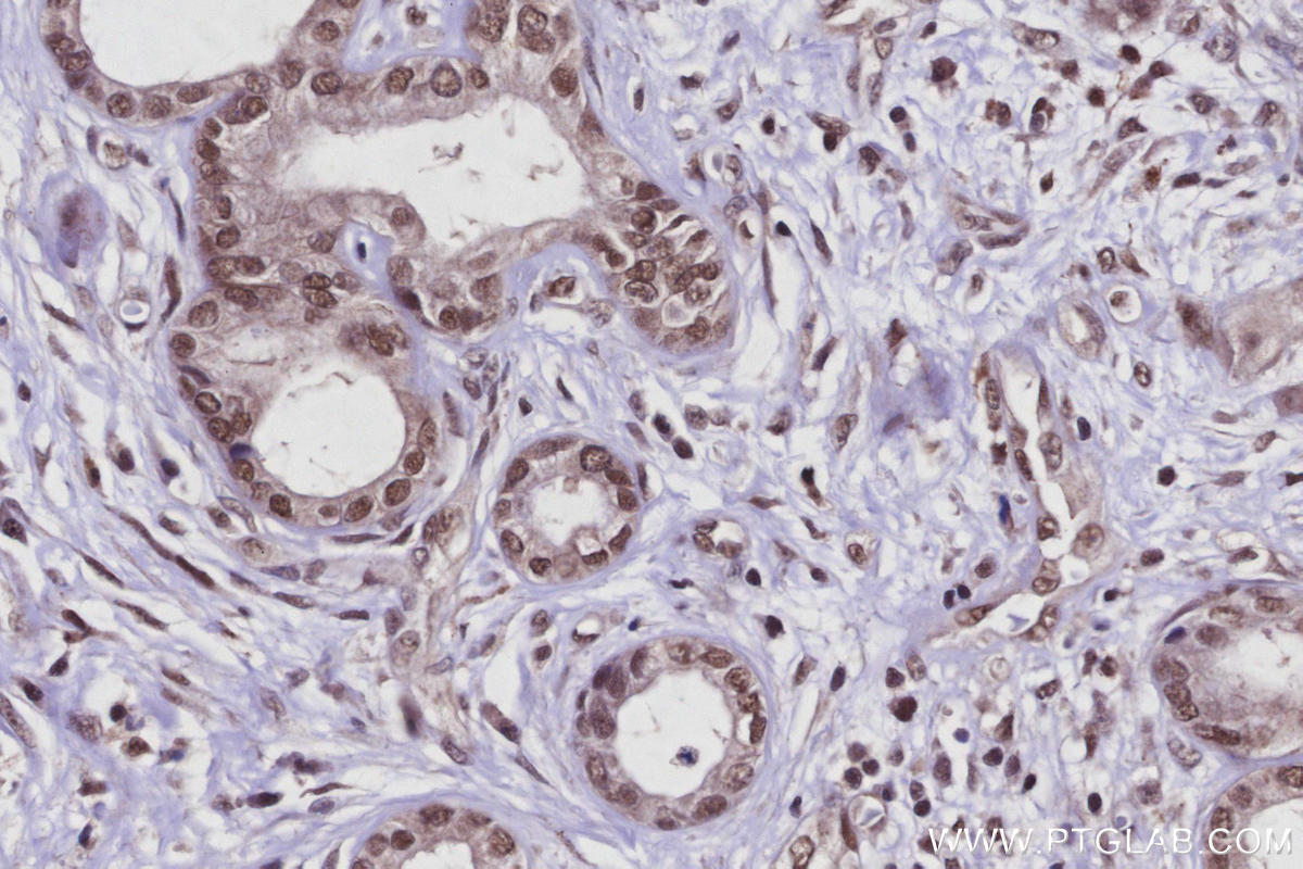 IHC staining of human pancreas cancer using 21505-1-AP Immunohistochemistry (IHC) staining of human pancreas cancer tissue using Arp5/ACTR5 Polyclonal antibody (21505-1-AP)