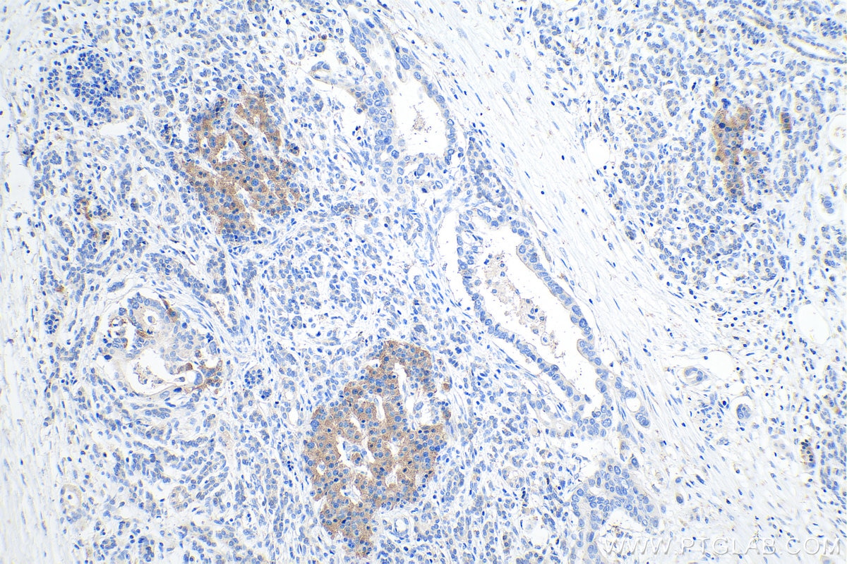 IHC staining of human pancreas cancer using 12610-1-AP