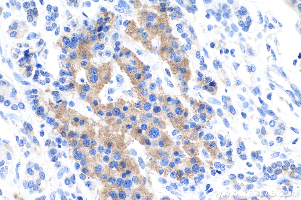IHC staining of human pancreas cancer using 12610-1-AP