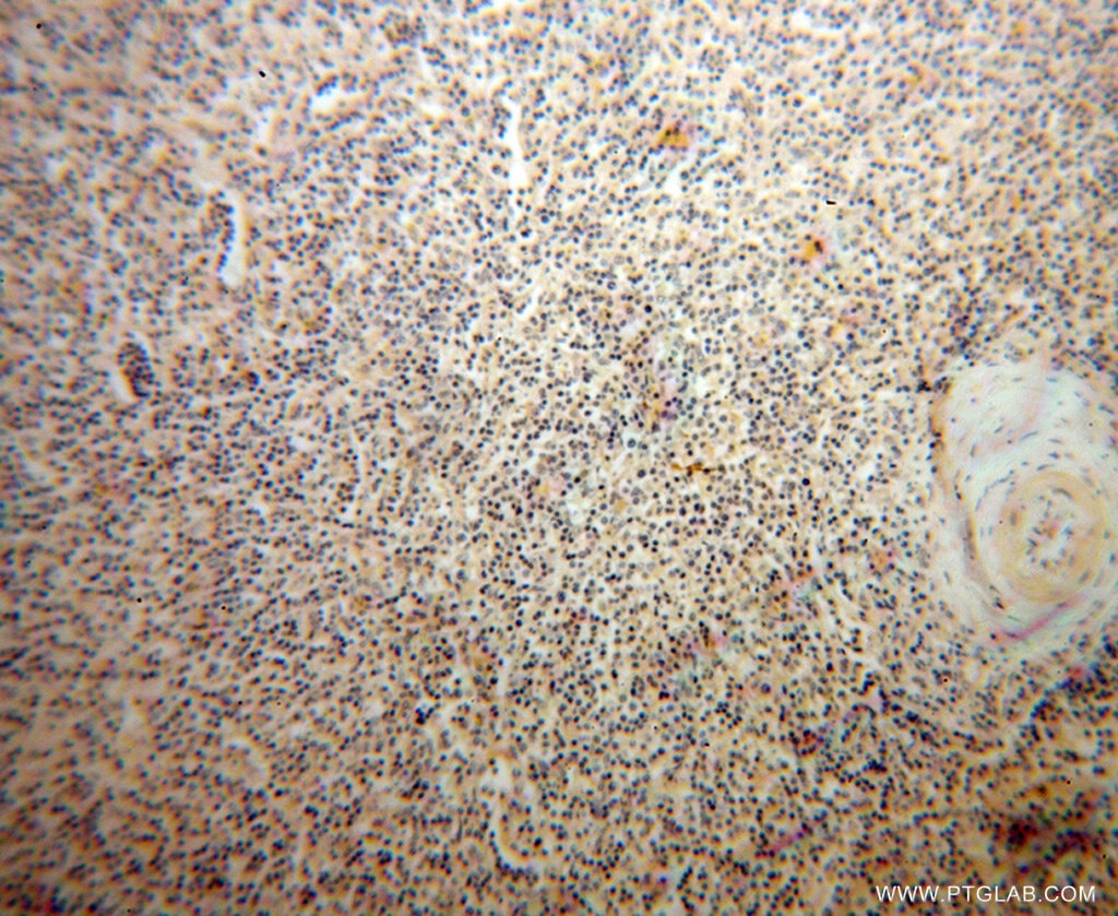 Immunohistochemistry (IHC) staining of human lymphoma tissue using ACVRL1 Polyclonal antibody (14745-1-AP)
