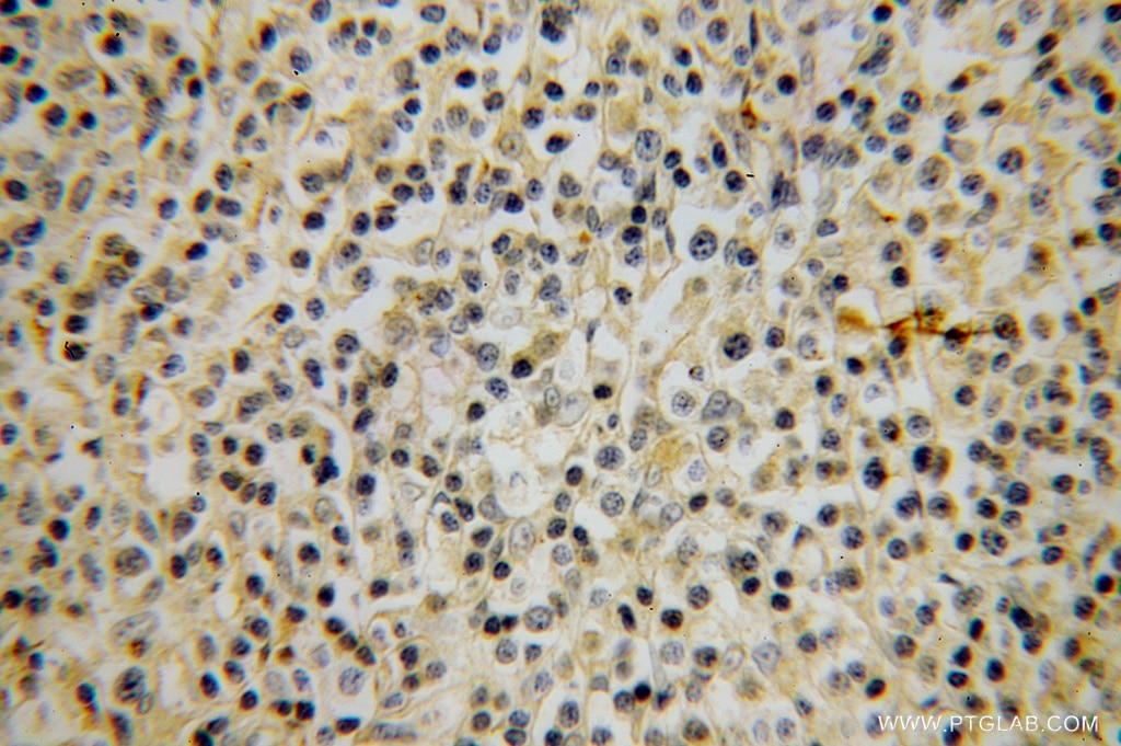 Immunohistochemistry (IHC) staining of human lymphoma tissue using ACVRL1 Polyclonal antibody (14745-1-AP)