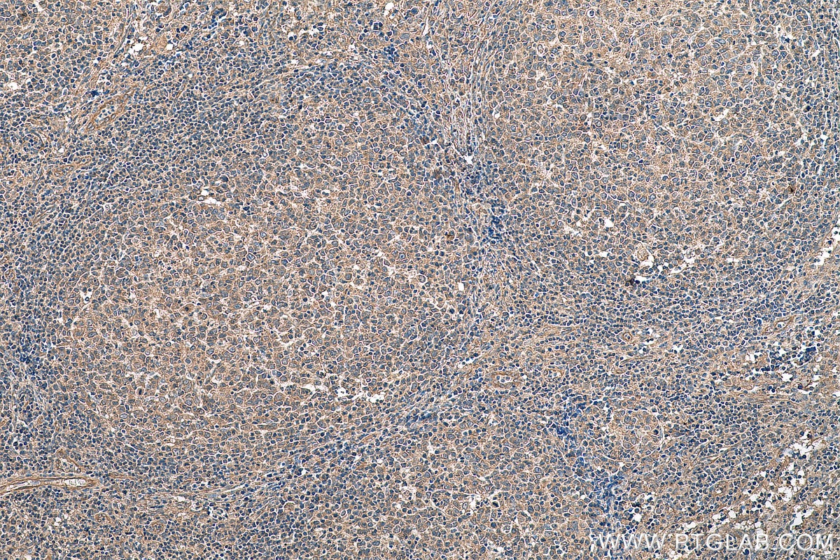 IHC staining of human lymphoma using 66857-1-Ig