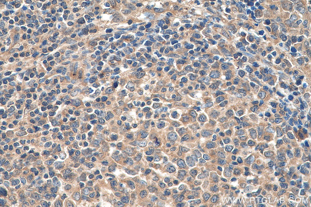 Immunohistochemistry (IHC) staining of human lymphoma tissue using ACVRL1 Monoclonal antibody (66857-1-Ig)