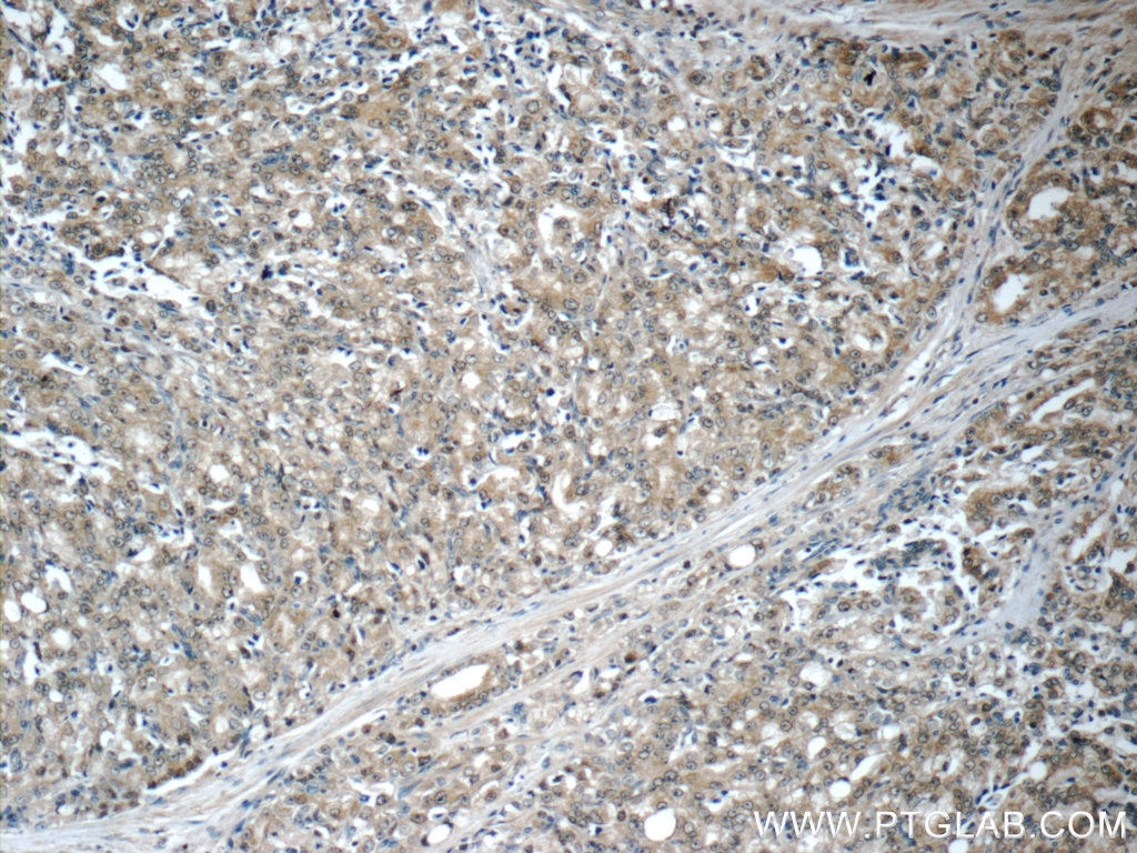 IHC staining of human prostate cancer using 11316-1-AP
