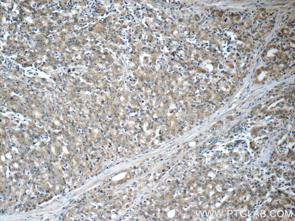 Immunohistochemistry (IHC) staining of human prostate cancer tissue using Aminoacylase 1 Polyclonal antibody (11316-1-AP)