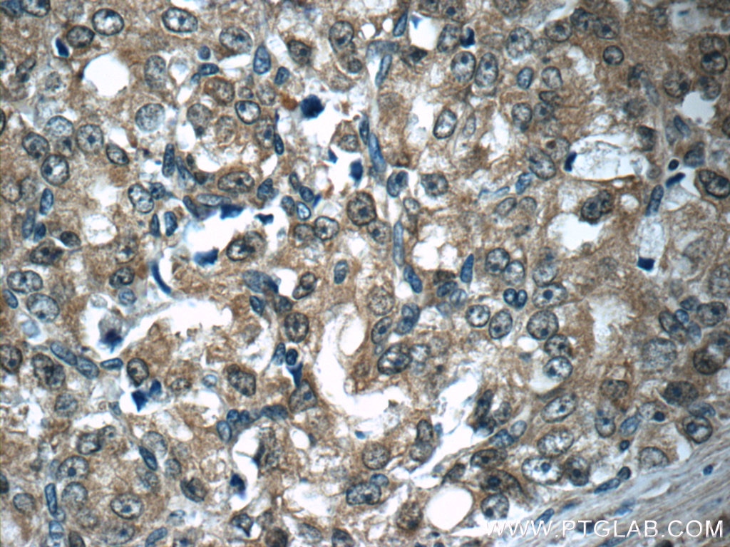 Immunohistochemistry (IHC) staining of human prostate cancer tissue using Aminoacylase 1 Polyclonal antibody (11316-1-AP)