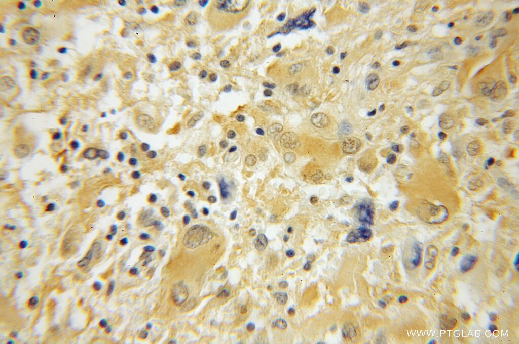 Immunohistochemistry (IHC) staining of human medulloblastoma tissue using ACYP2 Polyclonal antibody (12302-1-AP)