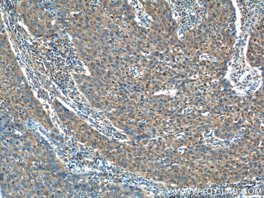 Immunohistochemistry (IHC) staining of human cervical cancer tissue using ADA Polyclonal antibody (13328-1-AP)