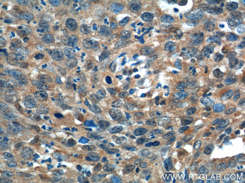 Immunohistochemistry (IHC) staining of human cervical cancer tissue using ADA Polyclonal antibody (13328-1-AP)