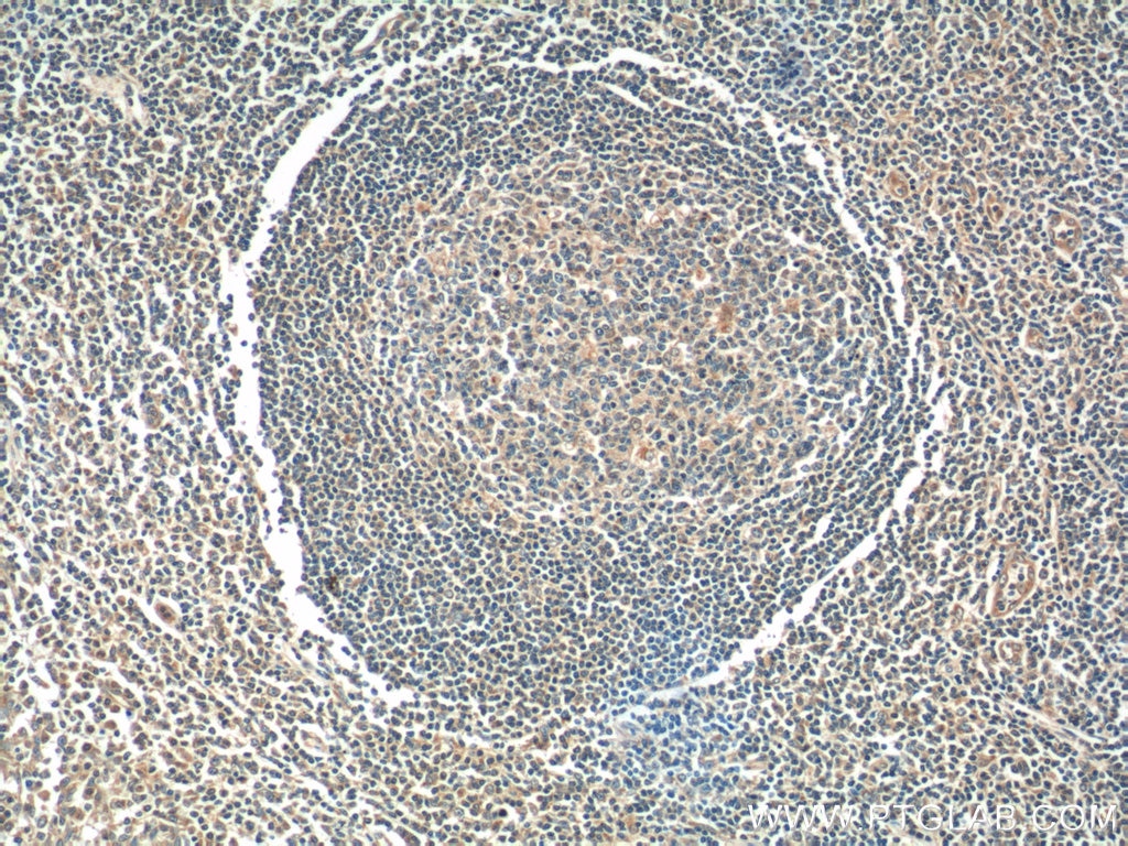 Immunohistochemistry (IHC) staining of human tonsillitis tissue using ADA Polyclonal antibody (13328-1-AP)