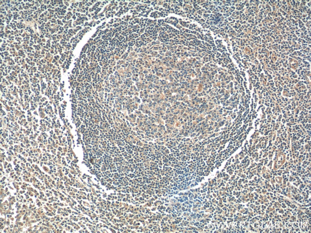 IHC staining of human tonsillitis using 13328-1-AP