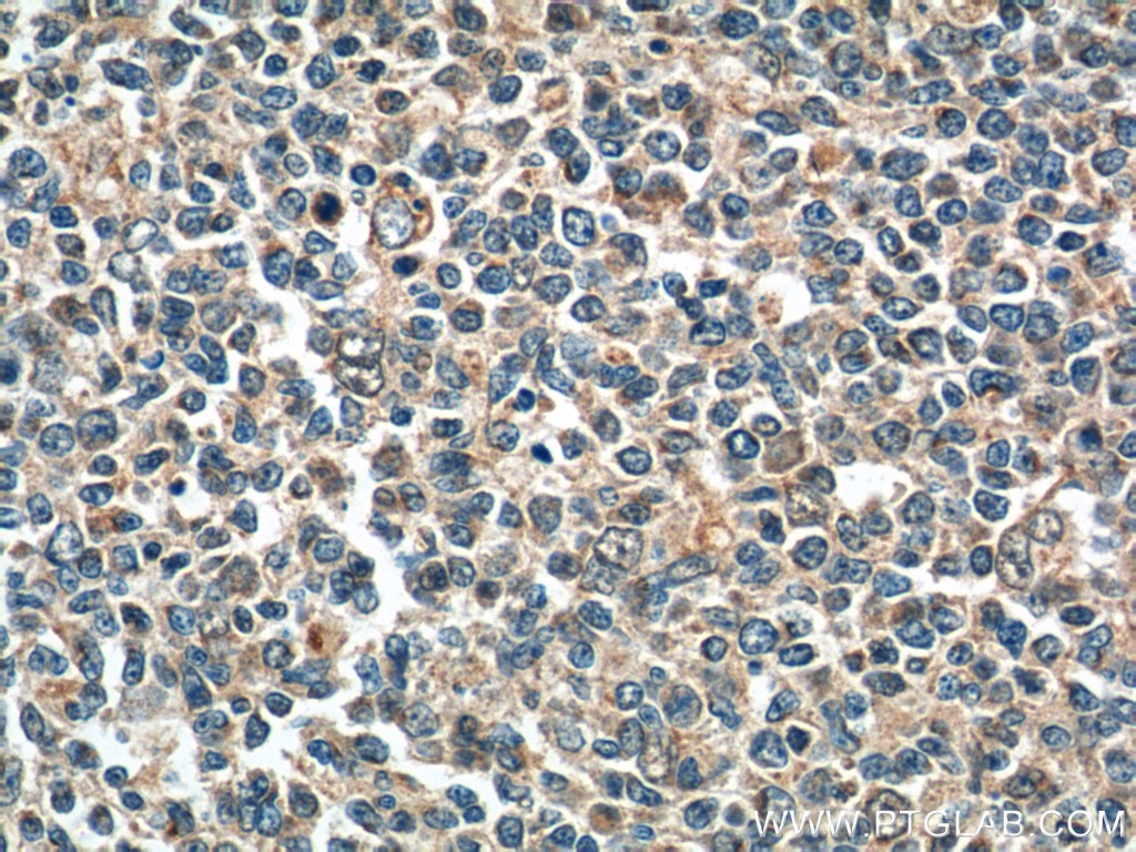 Immunohistochemistry (IHC) staining of human tonsillitis tissue using ADA Polyclonal antibody (13328-1-AP)