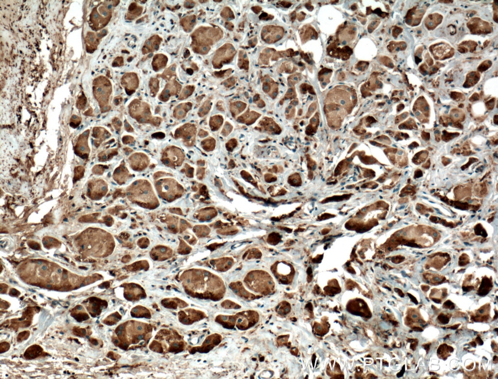Immunohistochemistry (IHC) staining of human breast cancer tissue using ADAL Polyclonal antibody (27369-1-AP)