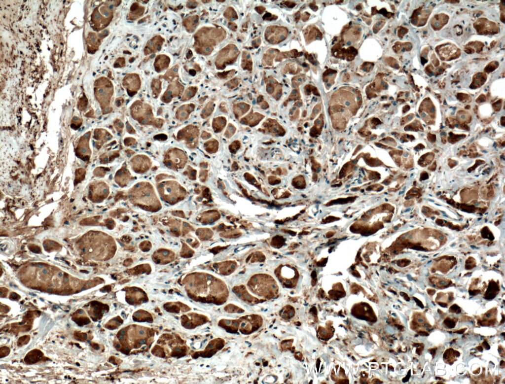 IHC staining of human breast cancer using 27369-1-AP