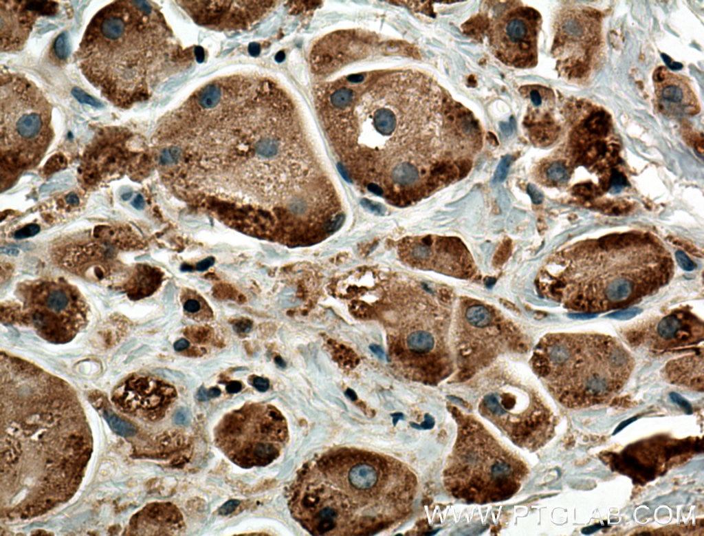 Immunohistochemistry (IHC) staining of human breast cancer tissue using ADAL Polyclonal antibody (27369-1-AP)