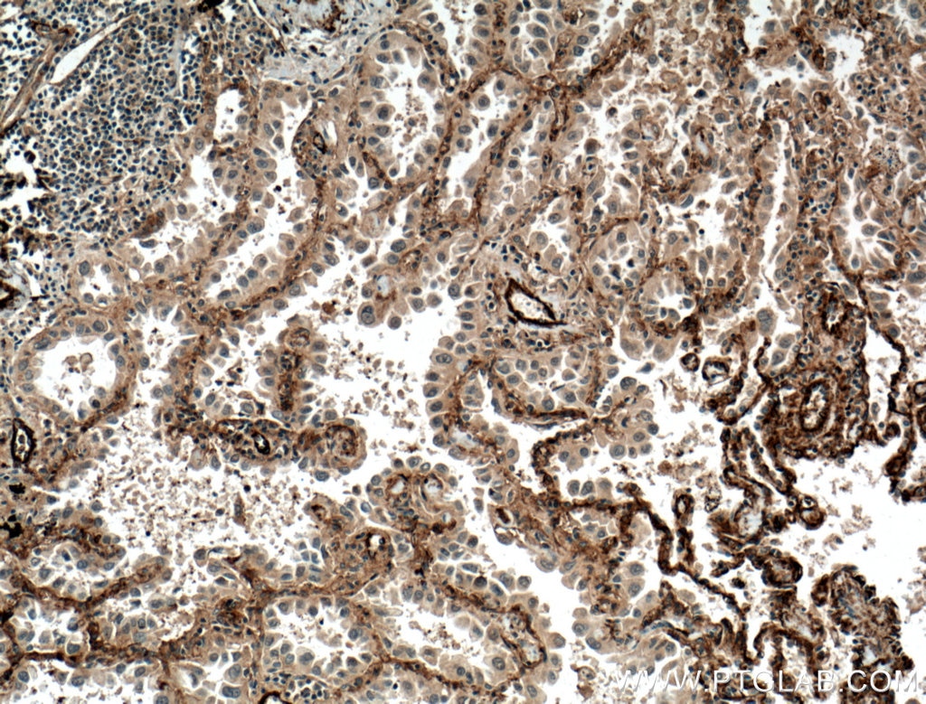 Immunohistochemistry (IHC) staining of human lung cancer tissue using ADAM10 Polyclonal antibody (25900-1-AP)