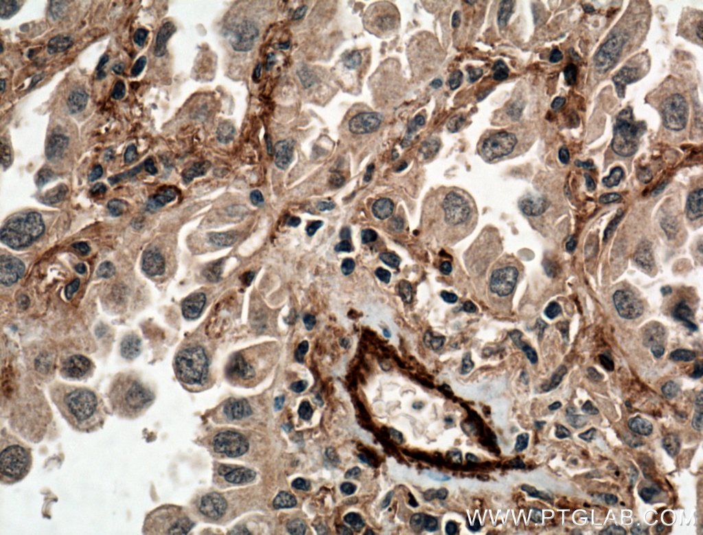 Immunohistochemistry (IHC) staining of human lung cancer tissue using ADAM10 Polyclonal antibody (25900-1-AP)