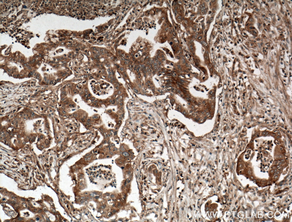 Immunohistochemistry (IHC) staining of human pancreas cancer tissue using ADAM10 Polyclonal antibody (25900-1-AP)