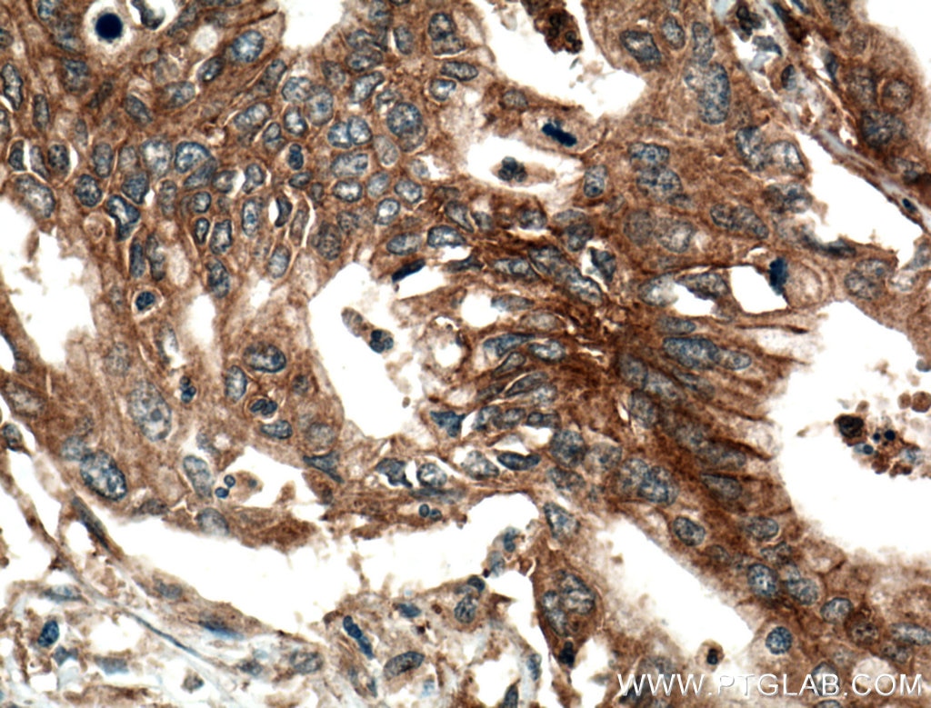 Immunohistochemistry (IHC) staining of human pancreas cancer tissue using ADAM10 Polyclonal antibody (25900-1-AP)