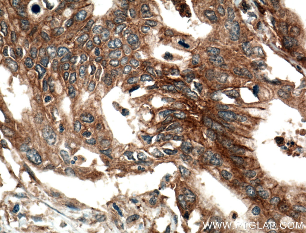 IHC staining of human pancreas cancer using 25900-1-AP