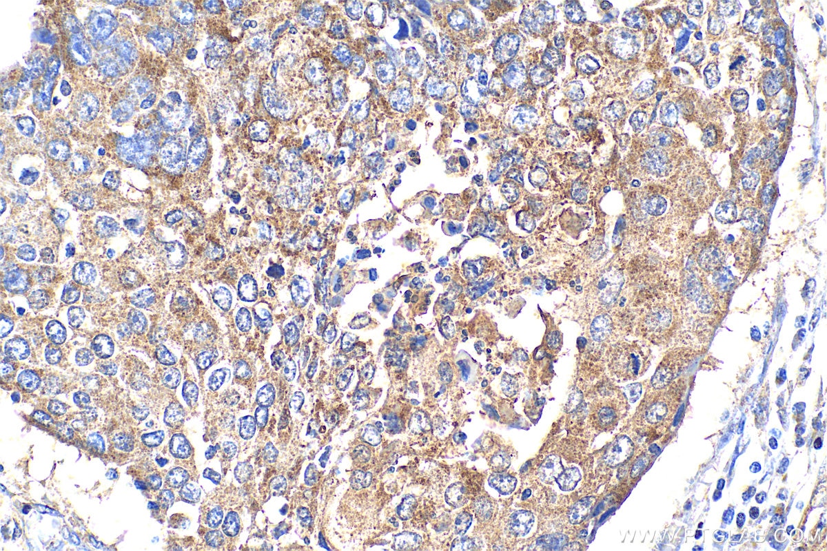 Immunohistochemistry (IHC) staining of human lung cancer tissue using ADAM10 Polyclonal antibody (25900-1-AP)