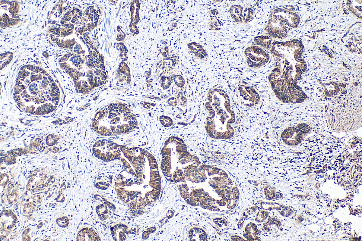Immunohistochemistry (IHC) staining of human pancreas cancer tissue using ADAM10 Polyclonal antibody (25900-1-AP)