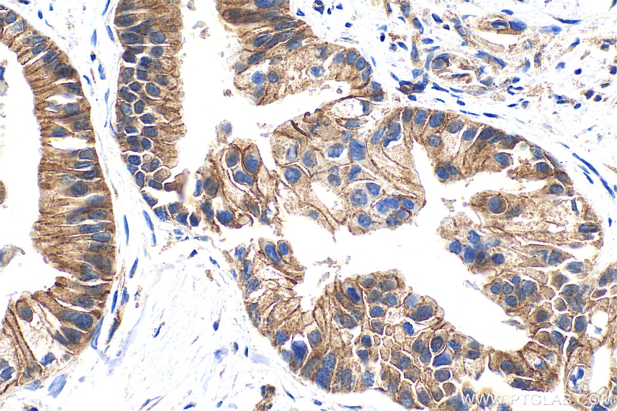 Immunohistochemistry (IHC) staining of human pancreas cancer tissue using ADAM10 Polyclonal antibody (25900-1-AP)