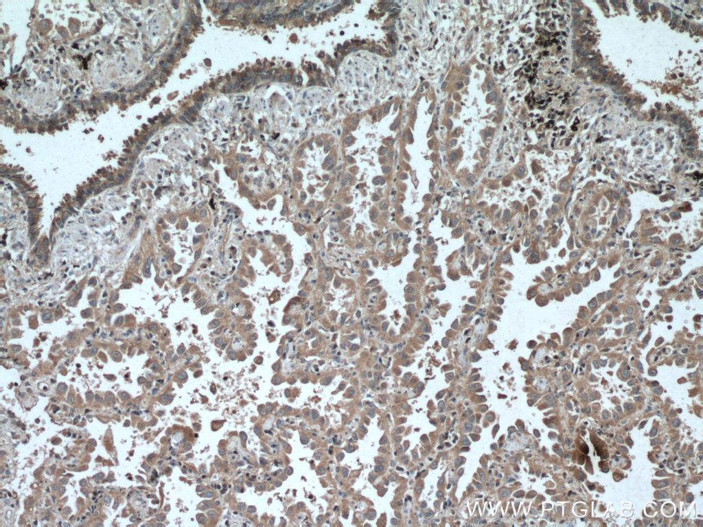 IHC staining of human lung cancer using 66620-1-Ig