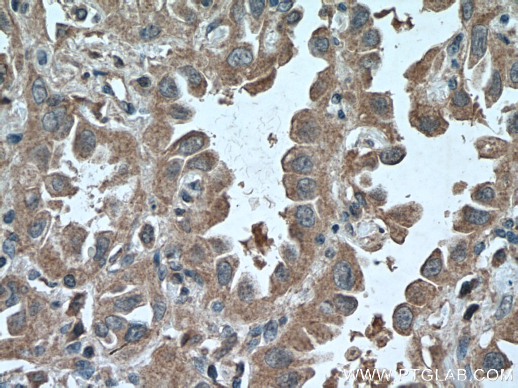 IHC staining of human lung cancer using 66620-1-Ig