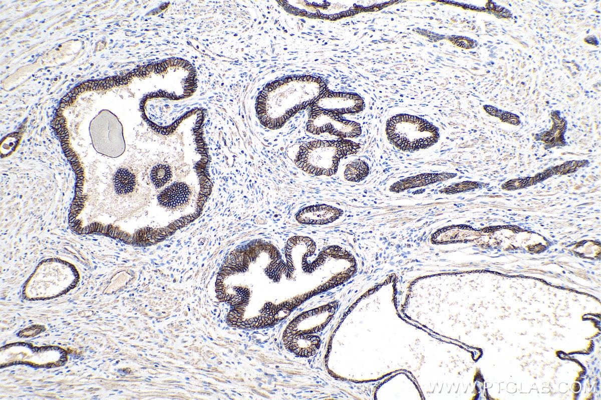 Immunohistochemistry (IHC) staining of human prostate cancer tissue using ADAM10 Monoclonal antibody (66620-1-Ig)