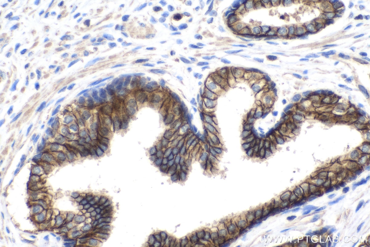 Immunohistochemistry (IHC) staining of human prostate cancer tissue using ADAM10 Monoclonal antibody (66620-1-Ig)