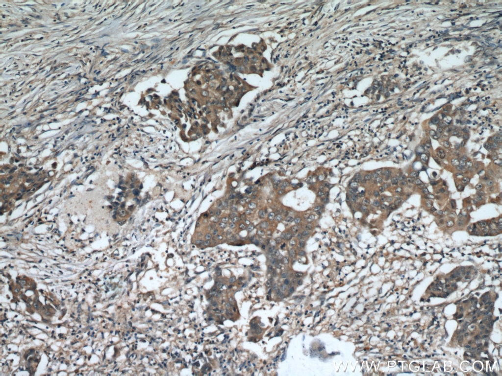 Immunohistochemistry (IHC) staining of human breast cancer tissue using ADAM12 Polyclonal antibody (14139-1-AP)